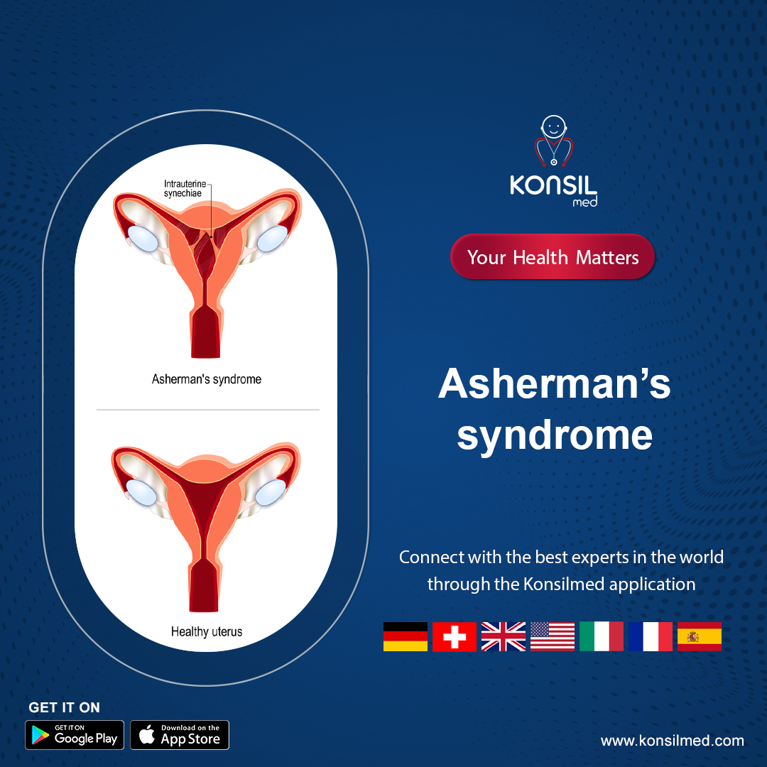 Do the Live Chat with a Doctor for your Asherman's syndrome